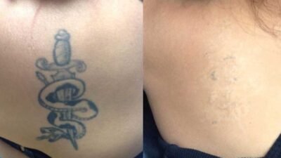 Is Safe and Effective Tattoo Removal Really Possible