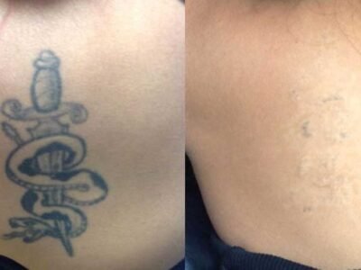 Is Safe and Effective Tattoo Removal Really Possible