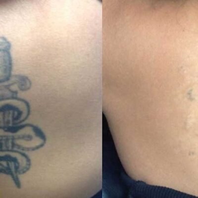 Is Safe and Effective Tattoo Removal Really Possible