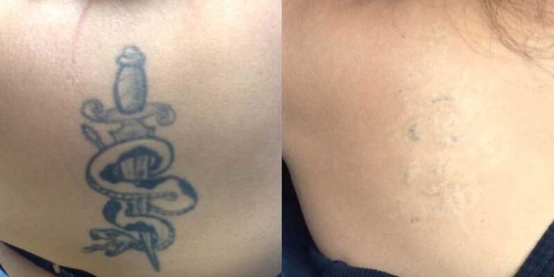 Is Safe and Effective Tattoo Removal Really Possible